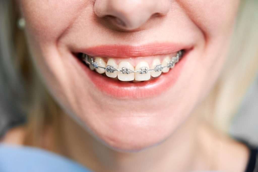 Primer plano de una persona sonriente mostrando aparatos metálicos, destacando la atención dental en la clínica dental Moratalaz. de Hospital Dental de Moratalaz "Martínez y Morcuende"