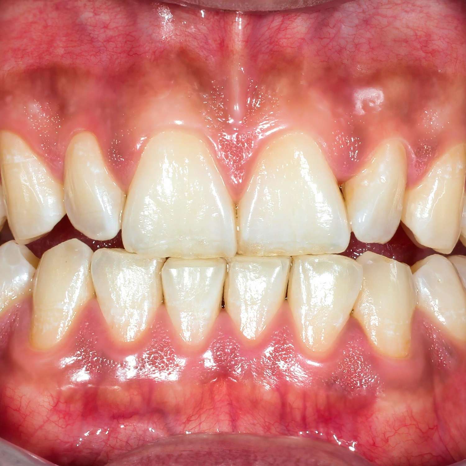 Primer plano de dientes y encías con leve desalineación, ideal para evaluación en una clínica dental Moratalaz o por un dentista especialista. de Hospital Dental de Moratalaz "Martínez y Morcuende"