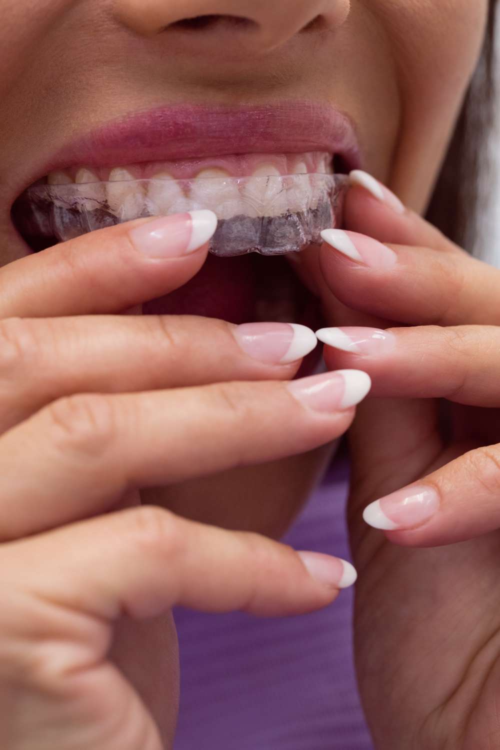 Una persona con las uñas cuidadas a la francesa se coloca un alineador de ortodoncia transparente en una clínica dental Moratalaz. de Hospital Dental de Moratalaz "Martínez y Morcuende"